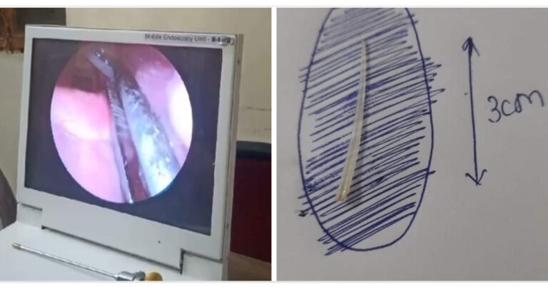 MP: जब मछली खाते समय गले में कांटा फस गया, डॉक्टर को इंडोस्कोपिक करनी पड़ी