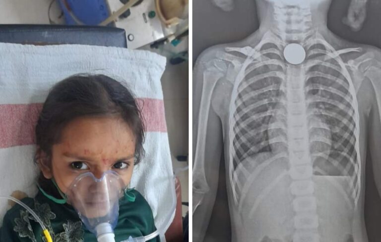 दमोह: 4 साल की बच्ची के गले में अटका सिक्का, इमरजेंसी ऑपरेशन कर निकाला गया